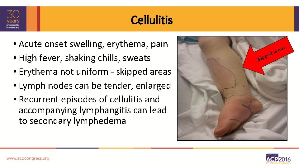 Cellulitis • Acute onset swelling, erythema, pain • High fever, shaking chills, sweats •