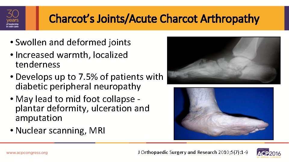 Charcot’s Joints/Acute Charcot Arthropathy • Swollen and deformed joints • Increased warmth, localized tenderness