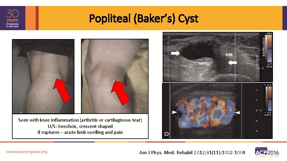 Popliteal (Baker’s) Cyst Seen with knee inflammation (arthritis or cartilaginous tear) U/S: Anechoic, crescent
