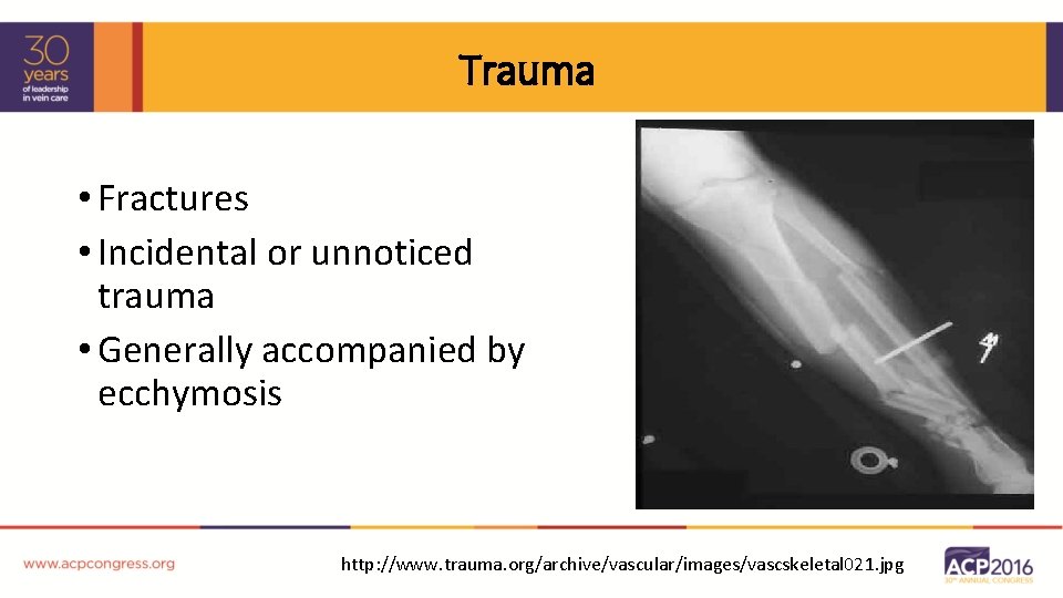 Trauma • Fractures • Incidental or unnoticed trauma • Generally accompanied by ecchymosis http: