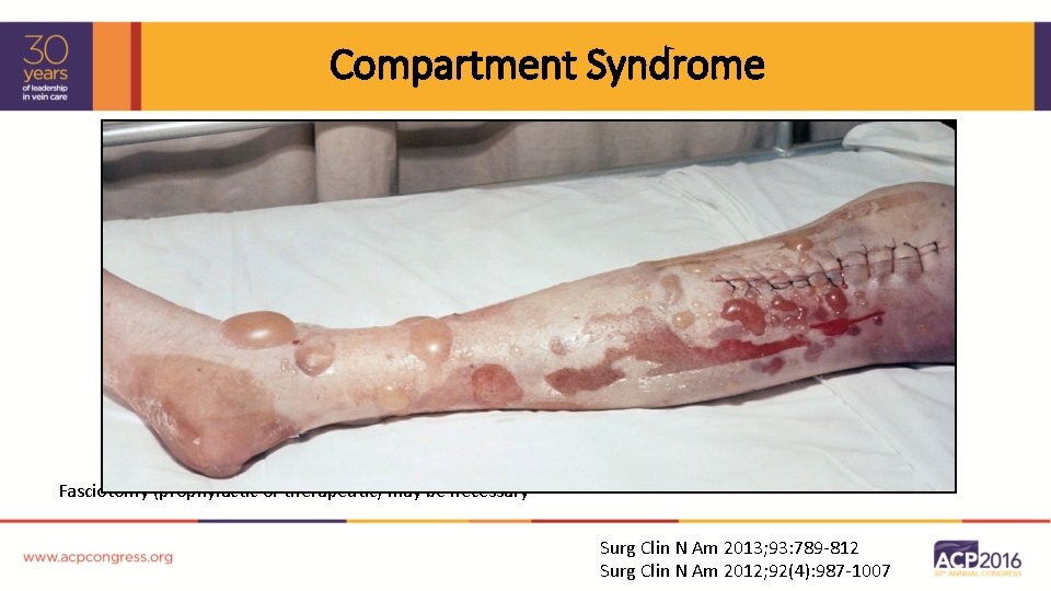 Compartment Syndrome Fasciotomy (prophylactic or therapeutic) may be necessary Surg Clin N Am 2013;