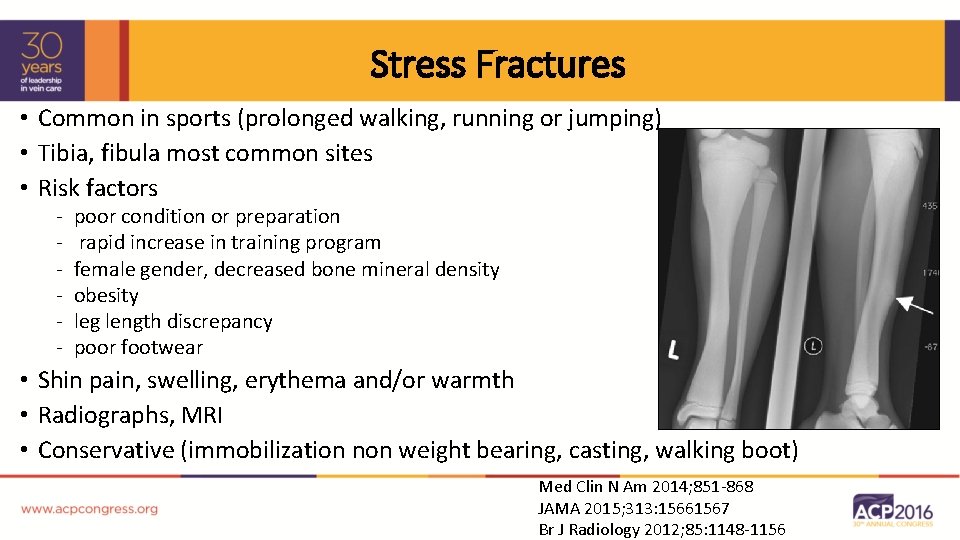 Stress Fractures • Common in sports (prolonged walking, running or jumping) • Tibia, fibula