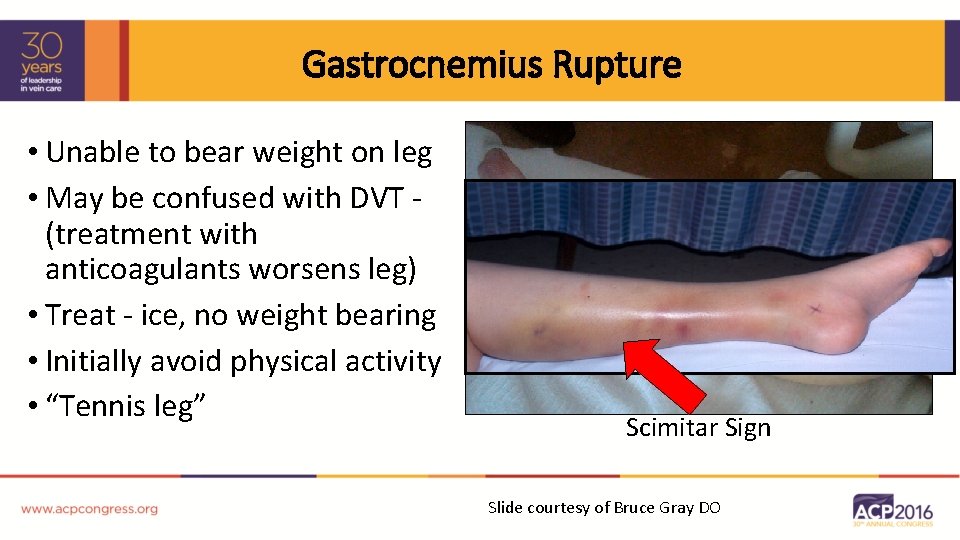 Gastrocnemius Rupture • Unable to bear weight on leg • May be confused with
