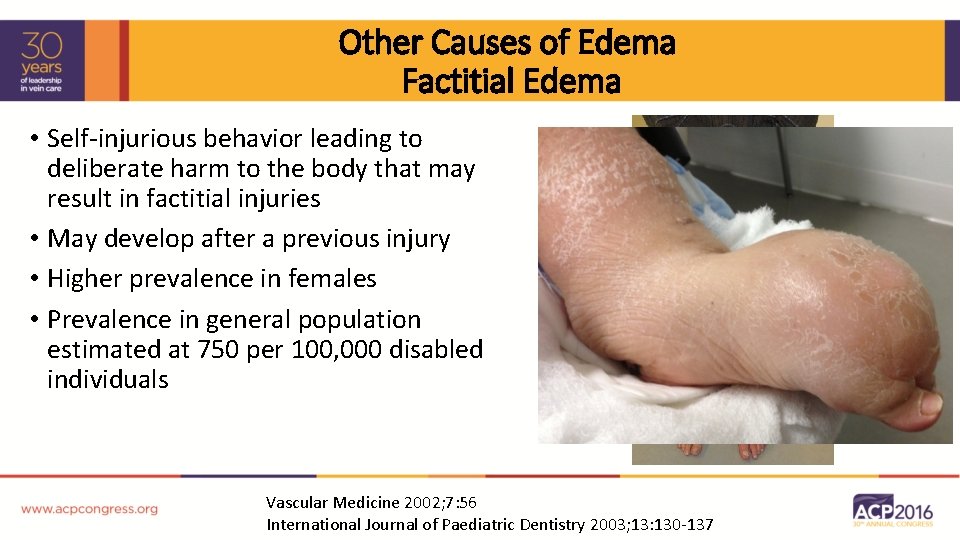 Other Causes of Edema Factitial Edema • Self-injurious behavior leading to deliberate harm to
