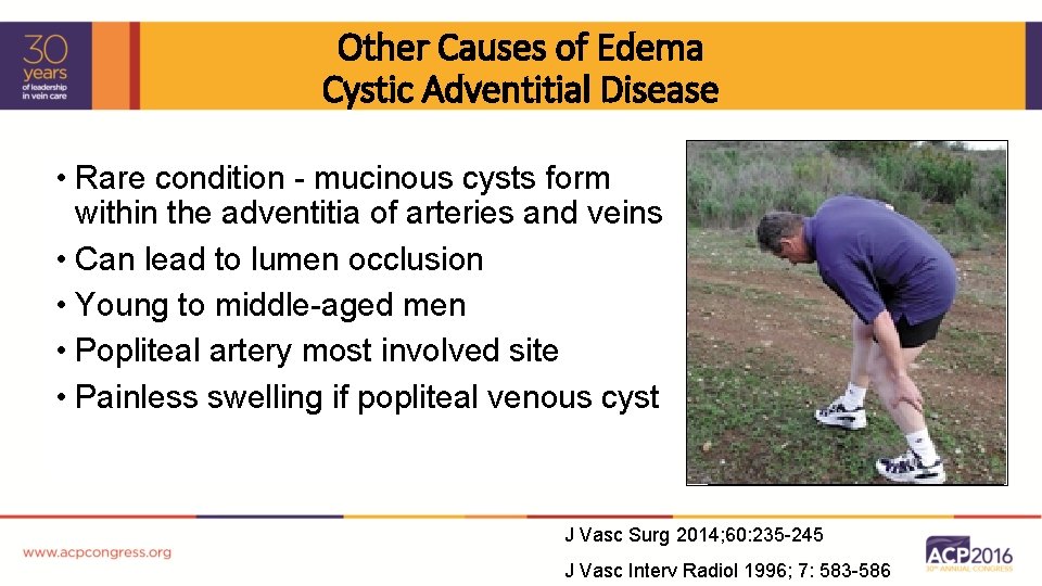 Other Causes of Edema Cystic Adventitial Disease • Rare condition - mucinous cysts form