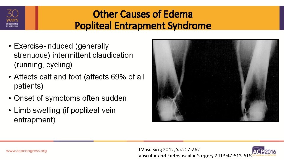 Other Causes of Edema Popliteal Entrapment Syndrome • Exercise-induced (generally strenuous) intermittent claudication (running,