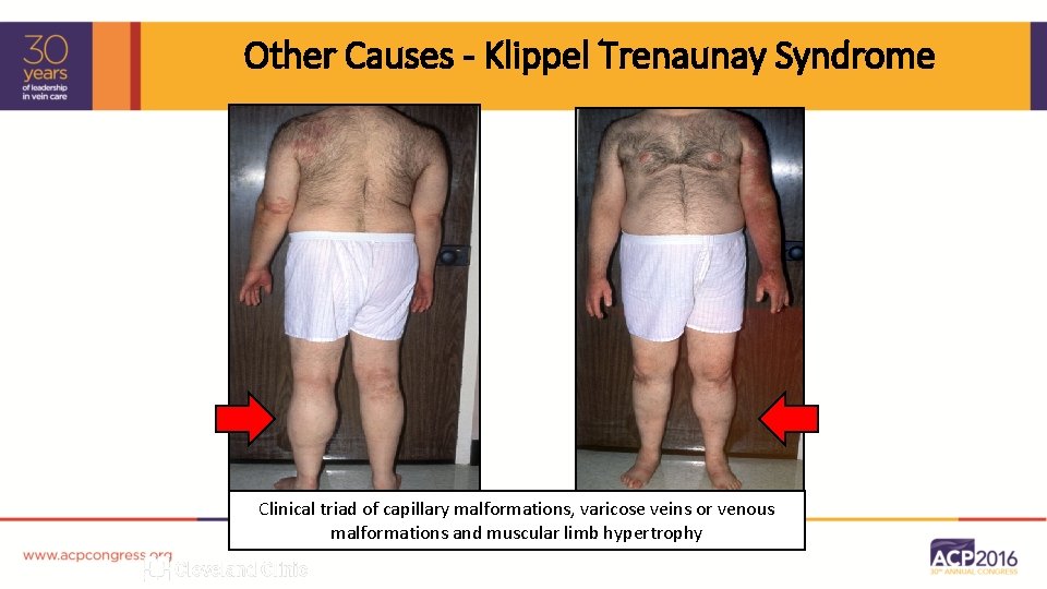Other Causes - Klippel Trenaunay Syndrome Clinical triad of capillary malformations, varicose veins or