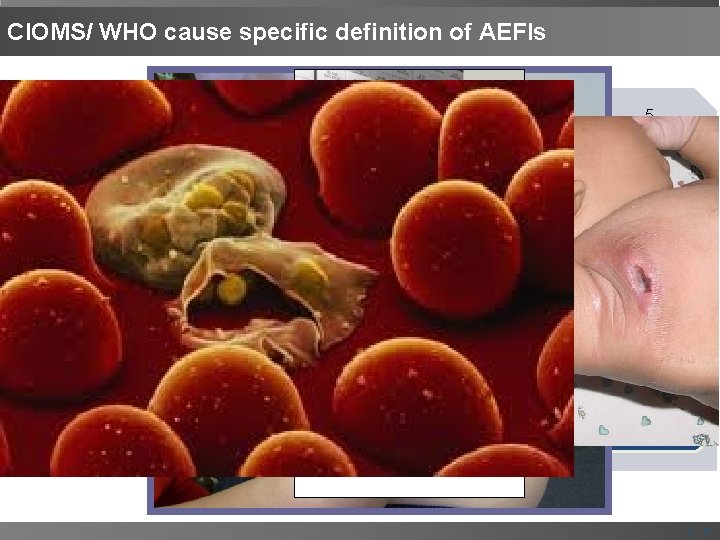 CIOMS/ WHO cause specific definition of AEFIs 1 Vaccine product -related reaction 2 Vaccine