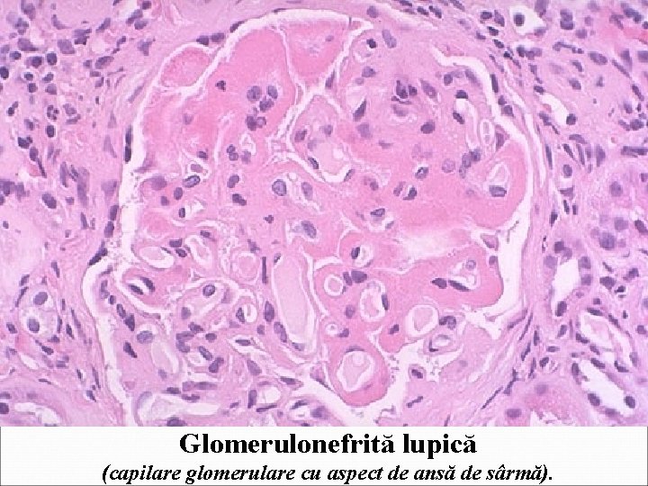 Glomerulonefrită lupică (capilare glomerulare cu aspect de ansă de sârmă). 