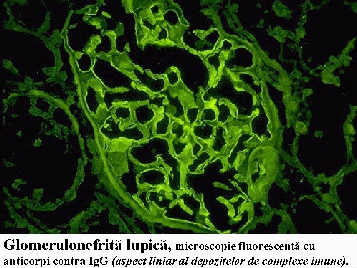 Glomerulonefrită lupică, microscopie fluorescentă cu anticorpi contra Ig. G (aspect liniar al depozitelor de