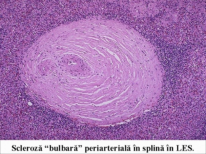 Scleroză “bulbară” periarterială în splină în LES. 