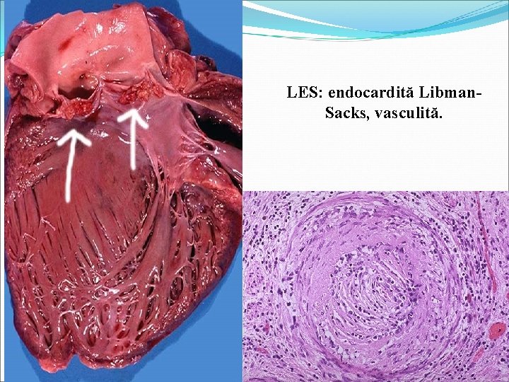 LES: endocardită Libman. Sacks, vasculită. 