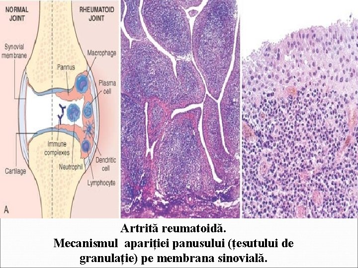 Artrită reumatoidă. Mecanismul apariției panusului (țesutului de granulație) pe membrana sinovială. 