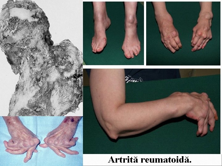 Artrită reumatoidă. 