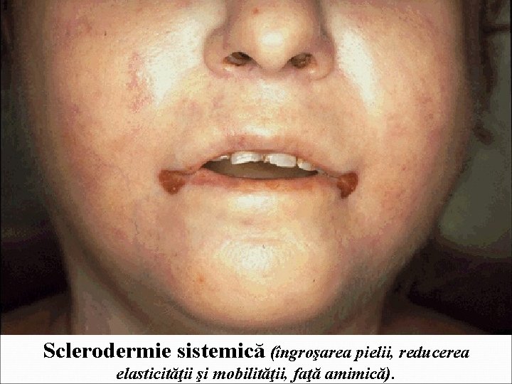 Sclerodermie sistemică (îngroşarea pielii, reducerea elasticităţii şi mobilităţii, faţă amimică). 