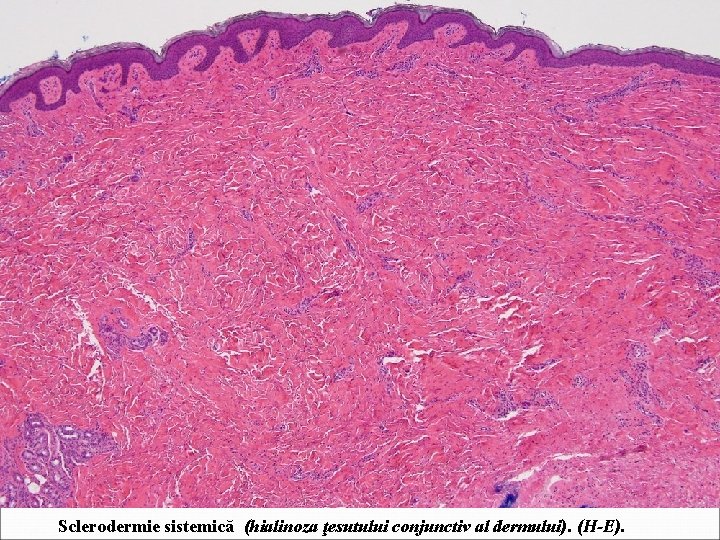 Sclerodermie sistemică (hialinoza ţesutului conjunctiv al dermului). (H-E). 