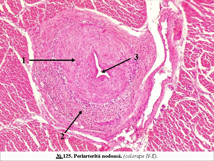 3 1 2 № 125. Periarterită nodoasă. (coloraţie H-E). 