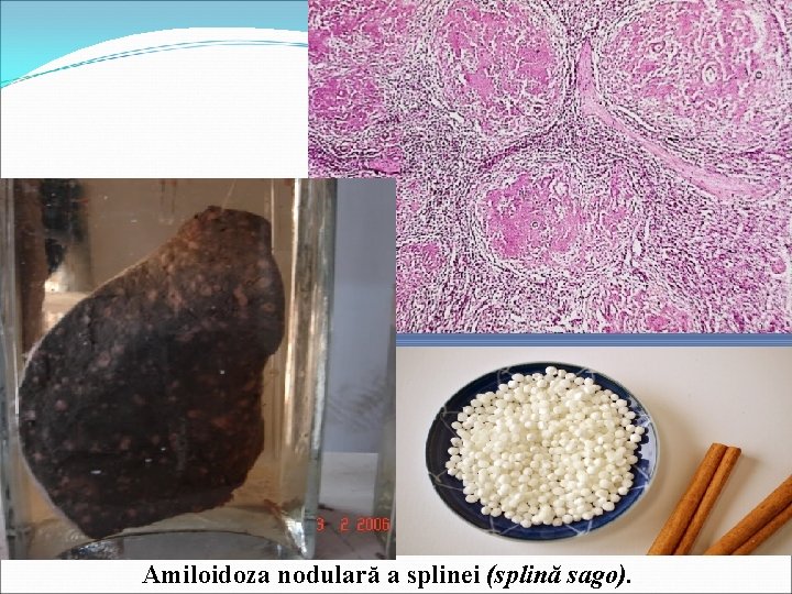 Amiloidoza nodulară a splinei (splină sago). 