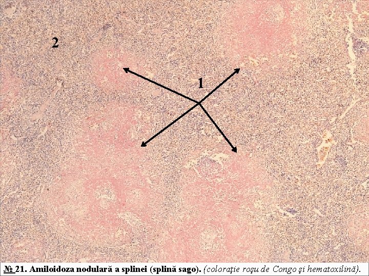 2 1 № 21. Amiloidoza nodulară a splinei (splină sago). (coloraţie roşu de Congo