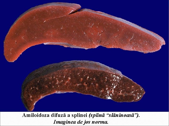 Amiloidoza difuză a splinei (splină “slăninoasă”). Imaginea de jos norma. 