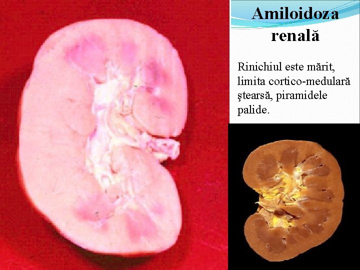 Amiloidoza renală Rinichiul este mărit, limita cortico-medulară ştearsă, piramidele palide. 