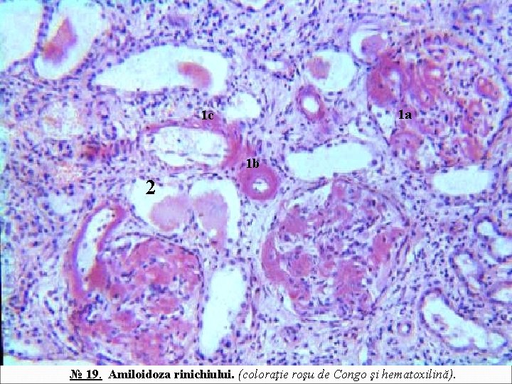 1 a 1 c 1 b 2 № 19. Amiloidoza rinichiului. (coloraţie roşu de