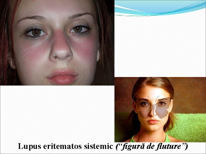 Lupus eritematos sistemic (“figură de fluture”) 