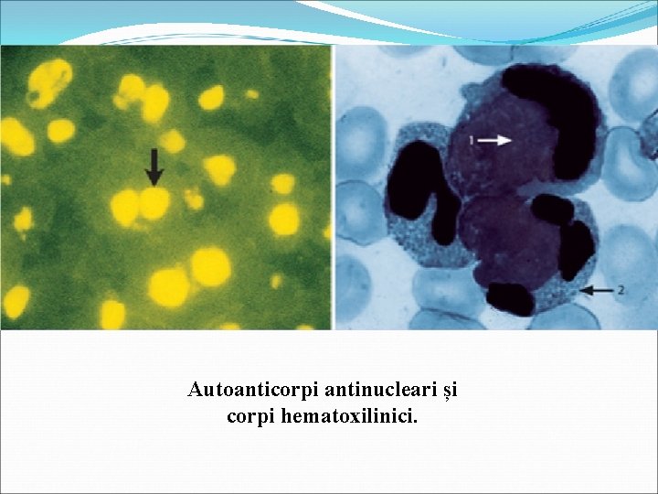 Autoanticorpi antinucleari și corpi hematoxilinici. 