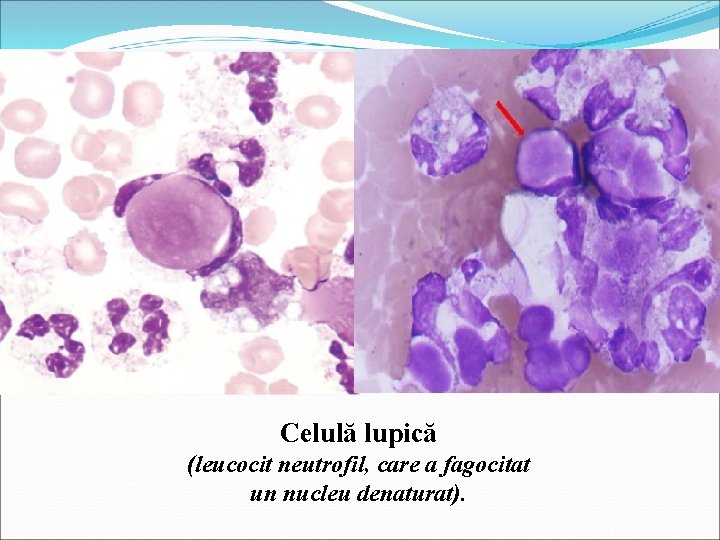 Celulă lupică (leucocit neutrofil, care a fagocitat un nucleu denaturat). 