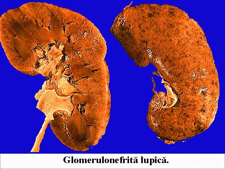 Glomerulonefrită lupică. 