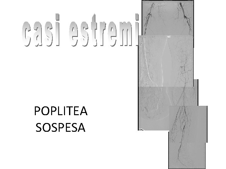 POPLITEA SOSPESA 