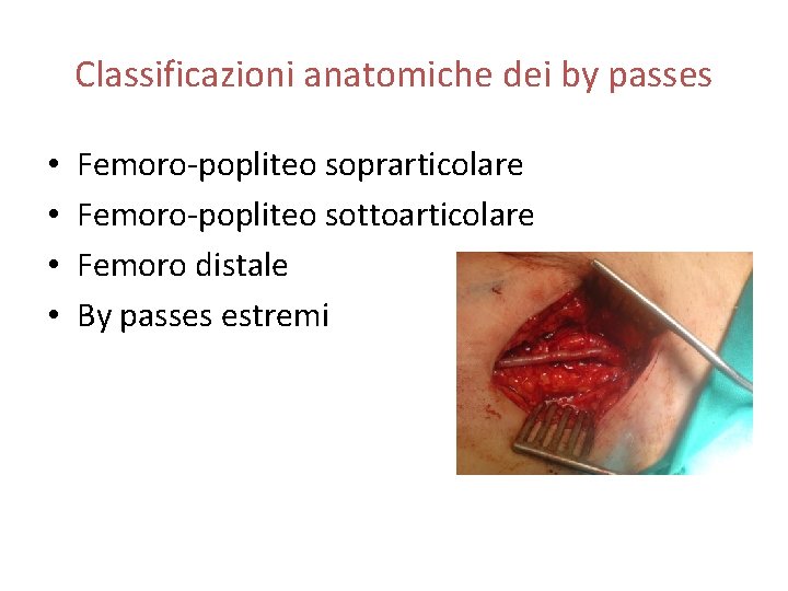 Classificazioni anatomiche dei by passes • • Femoro-popliteo soprarticolare Femoro-popliteo sottoarticolare Femoro distale By