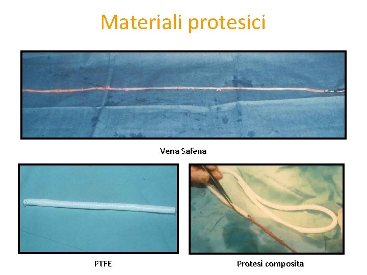 Materiali protesici Vena Safena PTFE Protesi composita 