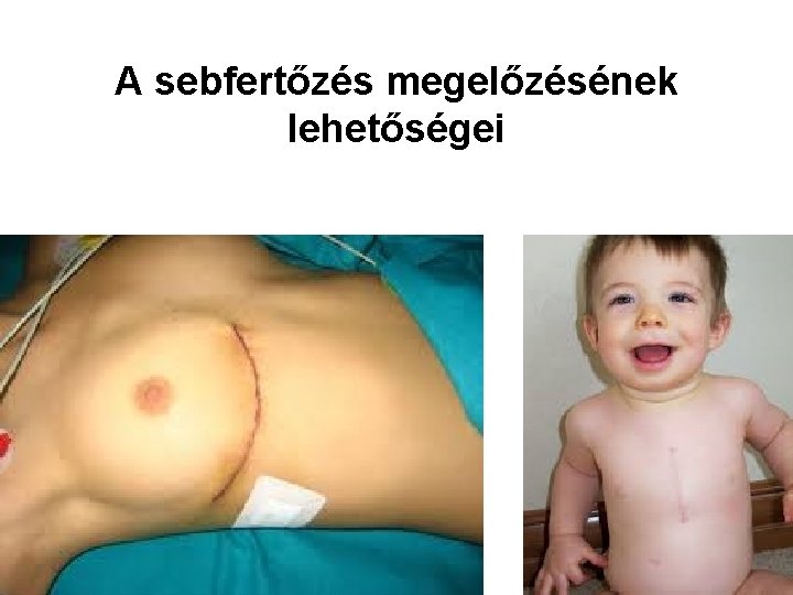 A sebfertőzés megelőzésének lehetőségei 