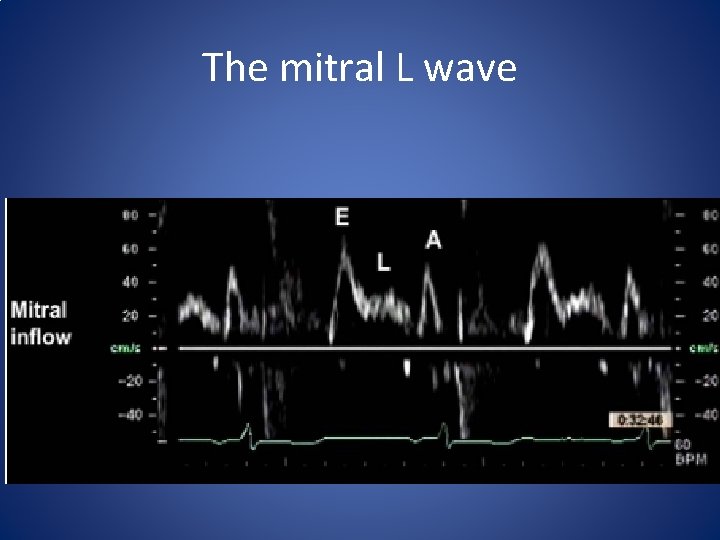 The mitral L wave 