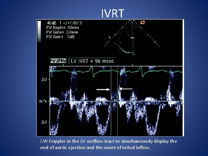  IVRT CW Doppler in the LV outflow tract to simultaneously display the end