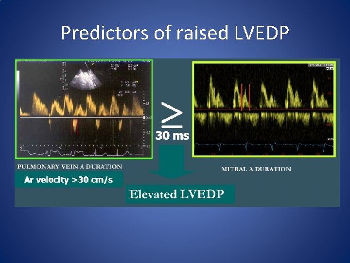 Predictors of raised LVEDP 
