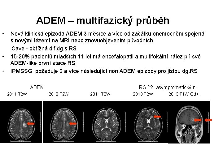 ADEM – multifazický průběh • Nová klinická epizoda ADEM 3 měsíce a více od