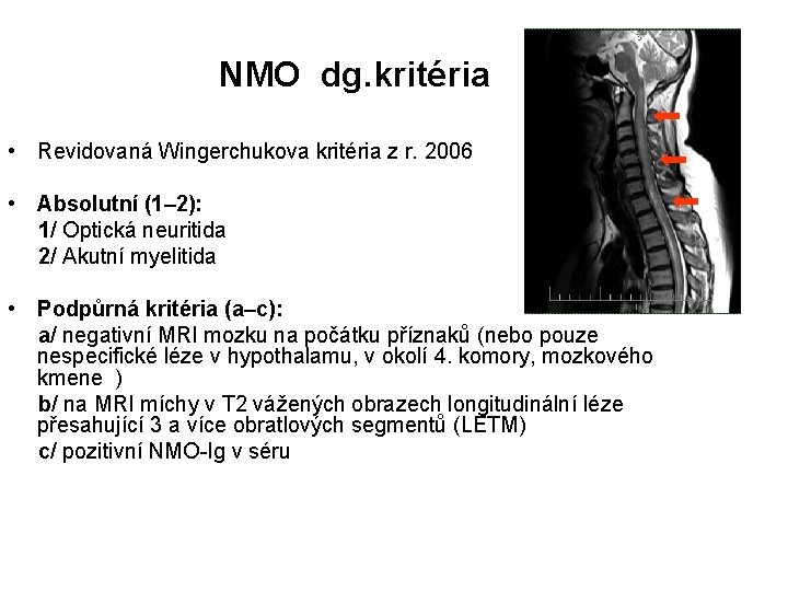 NMO dg. kritéria • Revidovaná Wingerchukova kritéria z r. 2006 • Absolutní (1– 2):