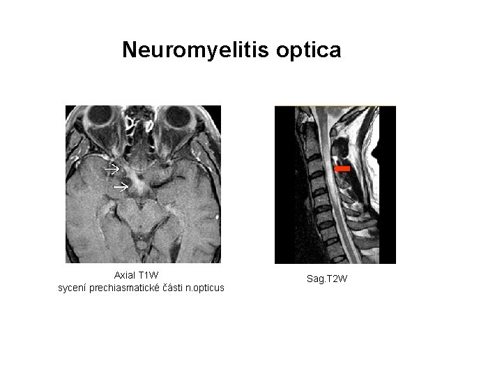 Neuromyelitis optica Axial T 1 W sycení prechiasmatické části n. opticus Sag. T 2