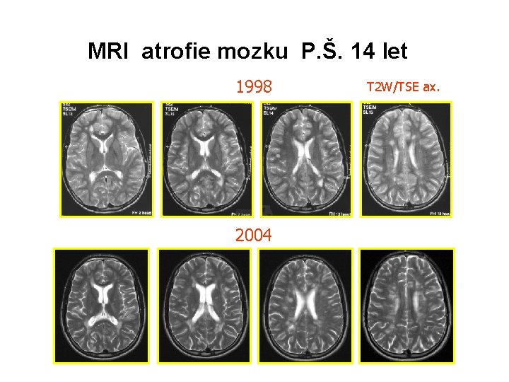  MRI atrofie mozku P. Š. 14 let 1998 2004 T 2 W/TSE ax.