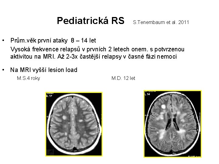  Pediatrická RS S. Tenembaum et al. 2011 • Prům. věk první ataky 8