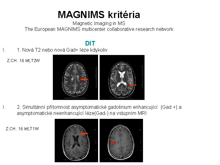 MAGNIMS kritéria Magnetic Imaging in MS The European MAGNIMS multicenter collaborative research network DIT