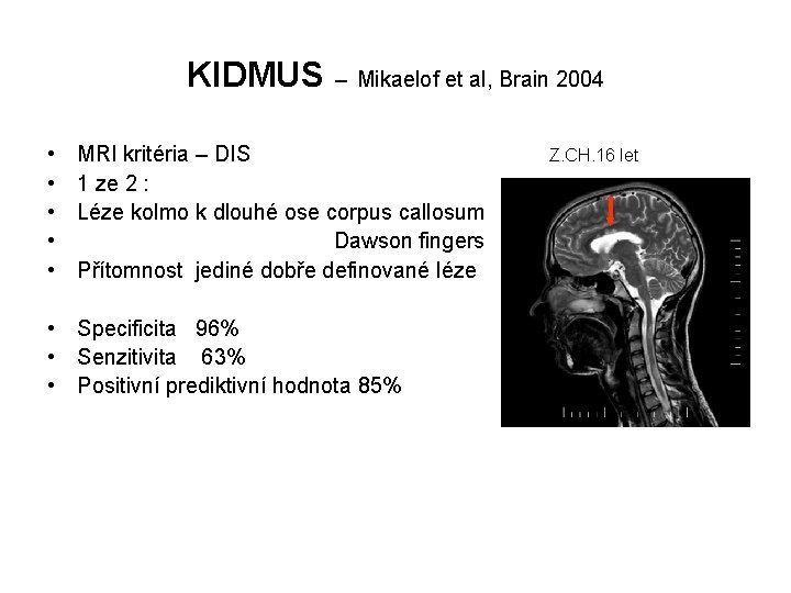 KIDMUS – Mikaelof et al, Brain 2004 • • • MRI kritéria – DIS