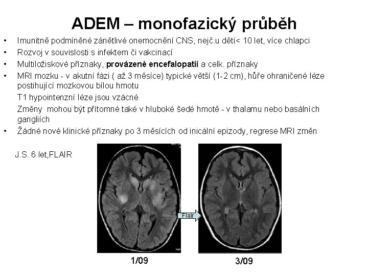 ADEM – monofazický průběh • • Imunitně podmíněné zánětlivé onemocnění CNS, nejč. u dětí<