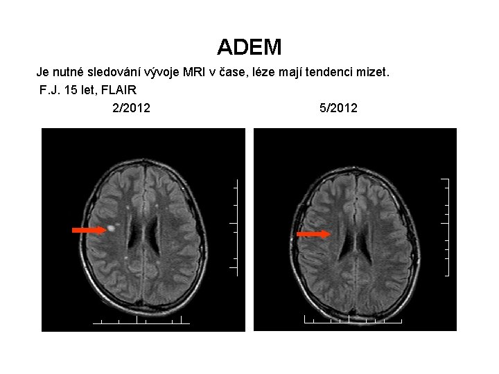 ADEM Je nutné sledování vývoje MRI v čase, léze mají tendenci mizet. F. J.
