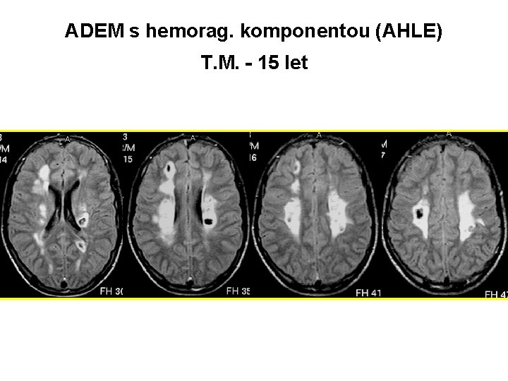  ADEM s hemorag. komponentou (AHLE) T. M. - 15 let 