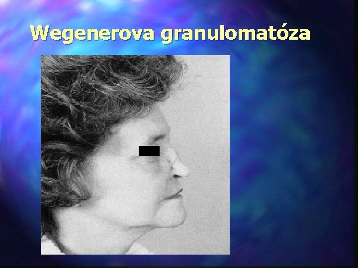 Wegenerova granulomatóza 