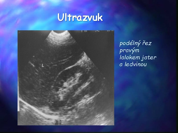 Ultrazvuk podélný řez pravým lalokem jater a ledvinou 