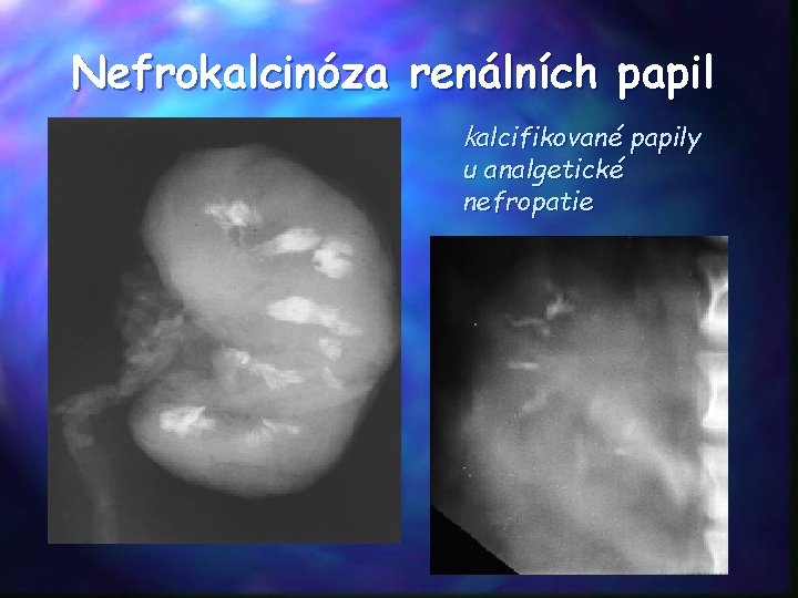 Nefrokalcinóza renálních papil kalcifikované papily u analgetické nefropatie 